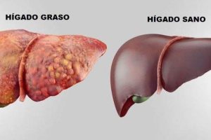 higado graso