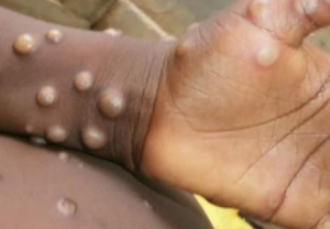 Lesiones de viruela del mono